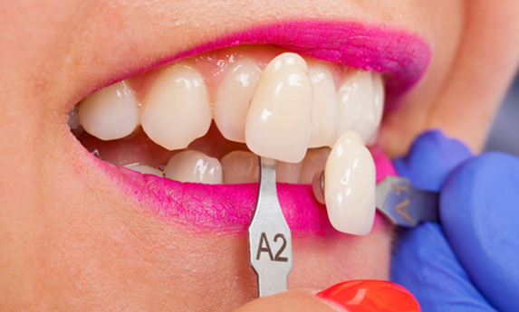 Why Would Porcelain Veneers Be Needed 2.jpg