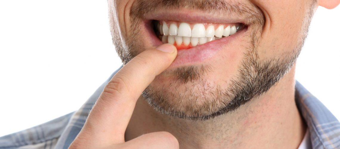 Gumfeat